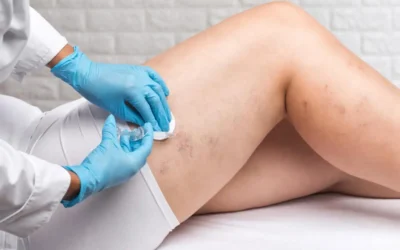 The Benefits of Choosing Sclerotherapy for Vein Treatment