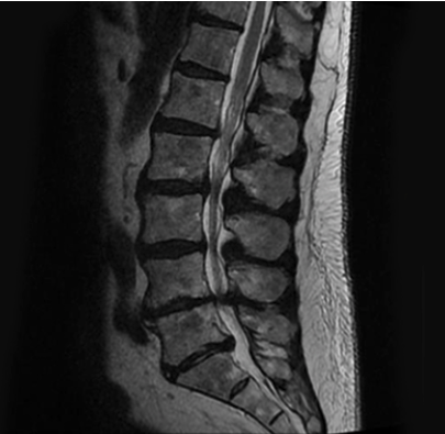 Degenerative Disc Disease - Physique