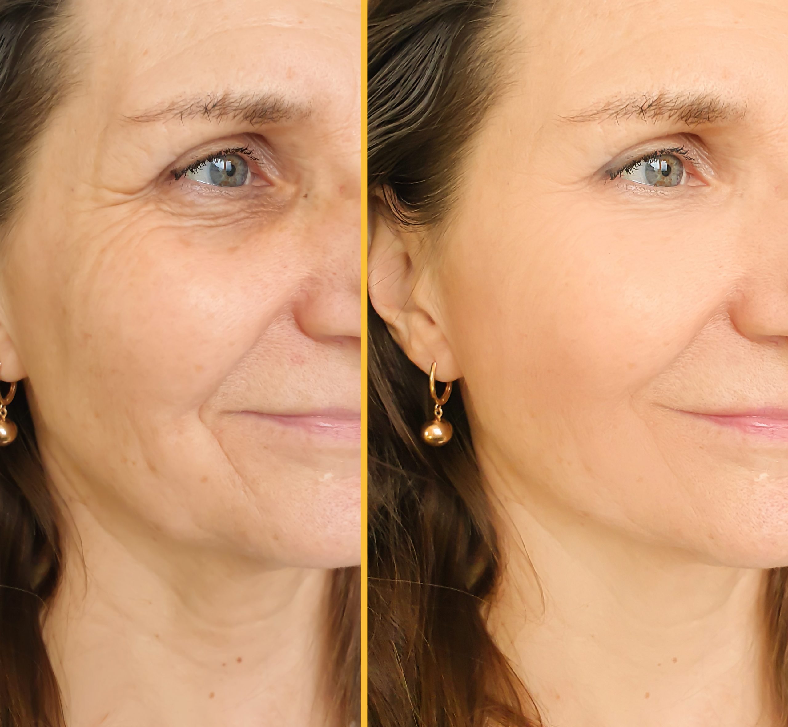 woman face wrinkles before and after treatment