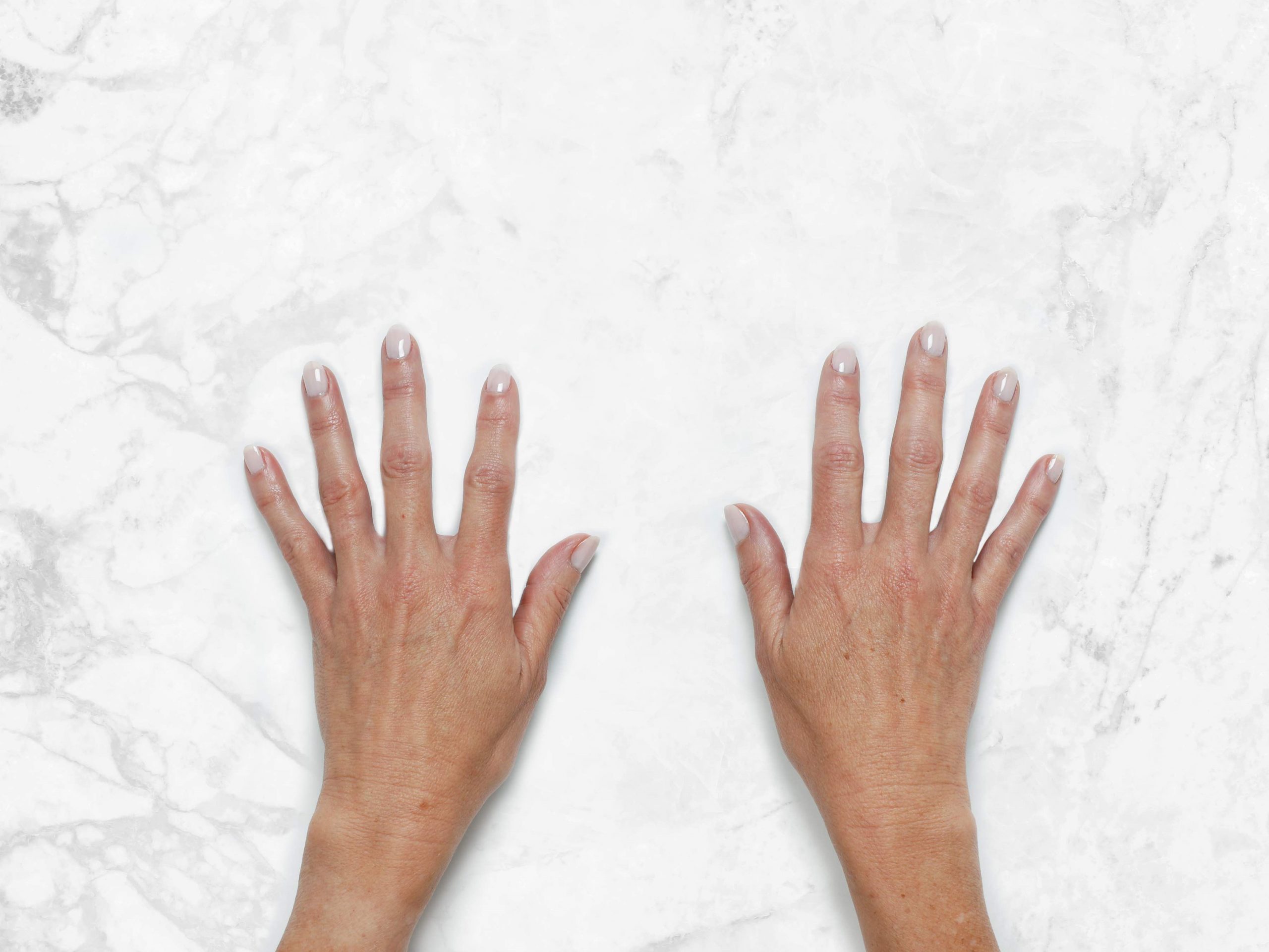 Bridget Hands Clinical Before