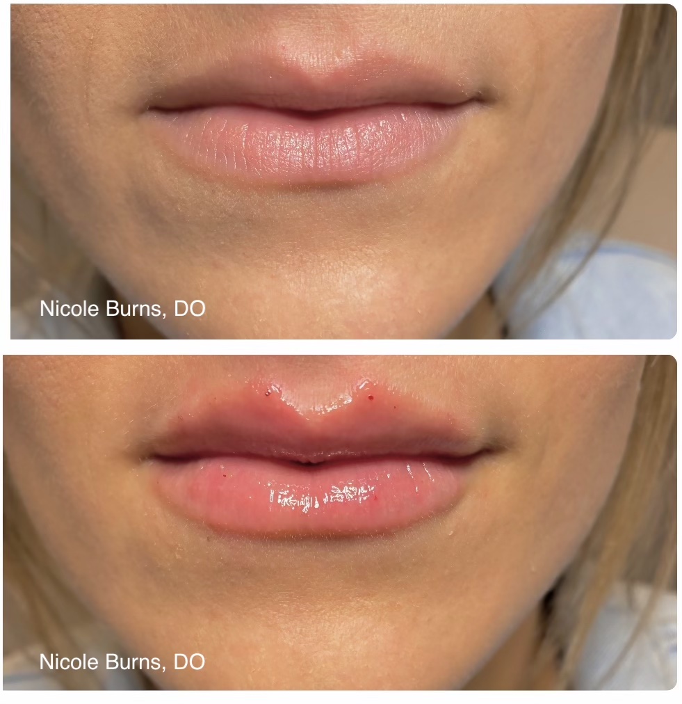 Lips 1