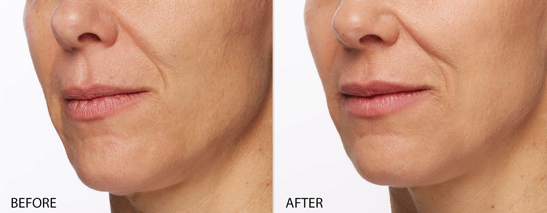 Restylane Silk