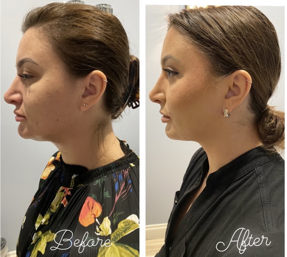 B Lively Kybella 1