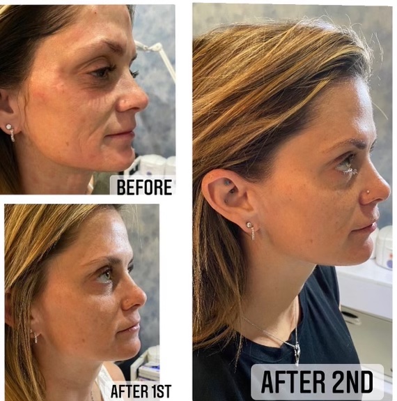 Female Facial Rejuvenation