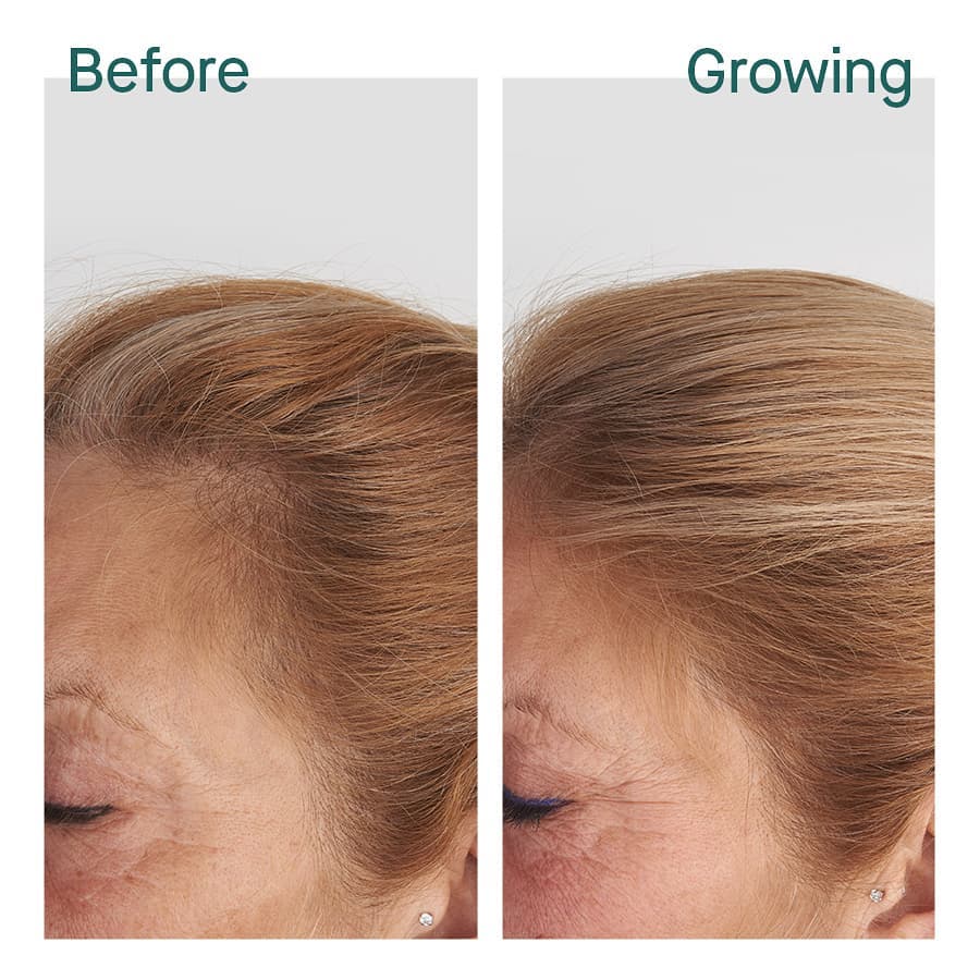 Hair Growth 2