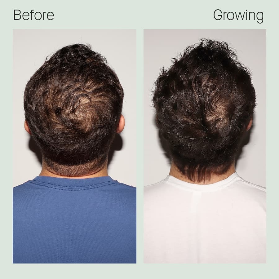 Hair Rejuvenation