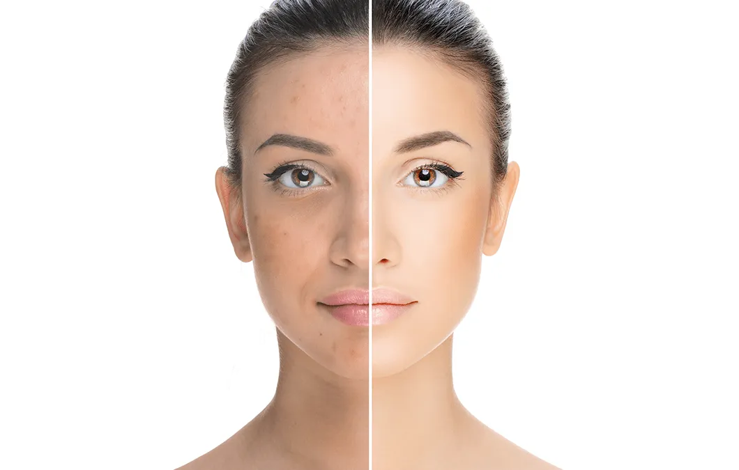 Acne Scarring: Understanding the Treatment Options