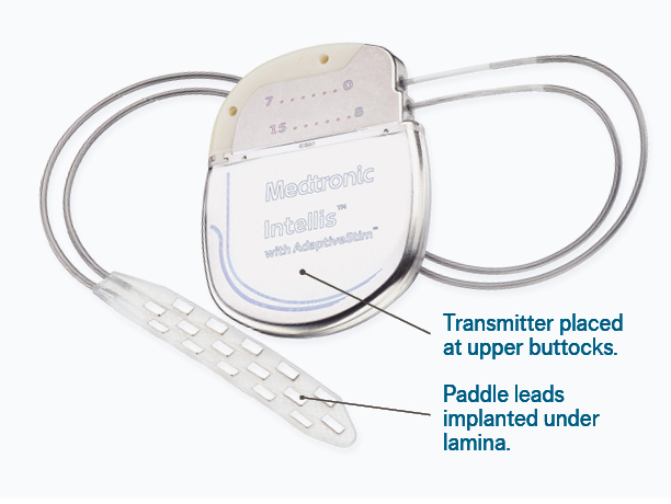 Spinal Cord Stimulation An Innovative Treatment For Chronic Pain