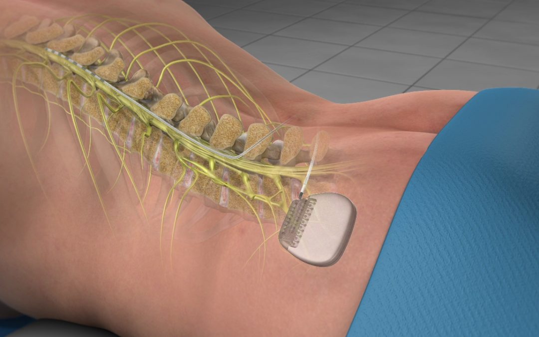 Spinal Cord Stimulation: An Innovative Treatment for Chronic Pain