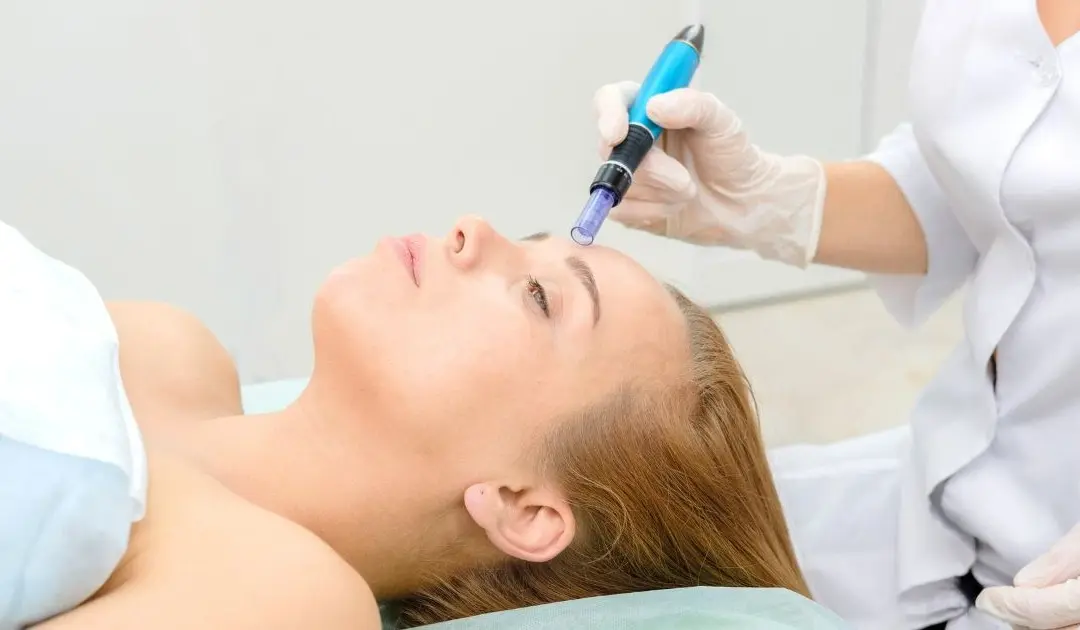 How PRP Microneedling Reduces Acne Scars and Fine Lines