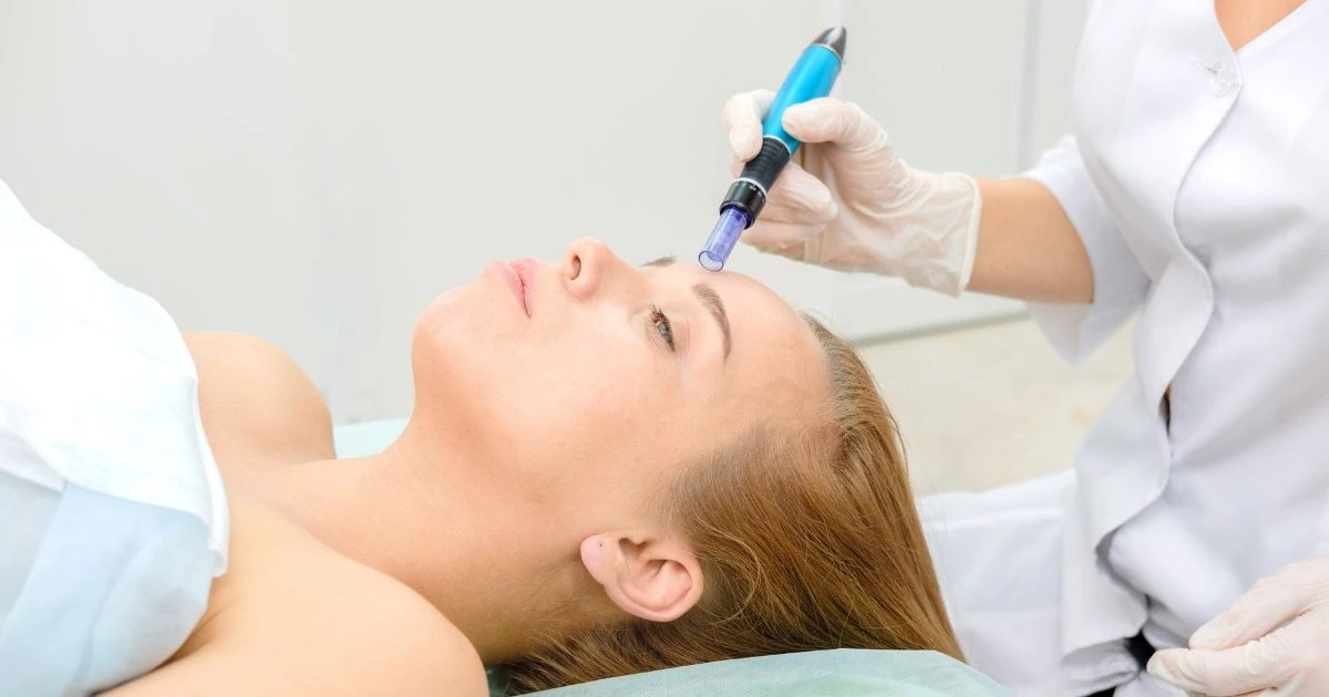 PRP microneedling treatment stimulating collagen for smoother skin