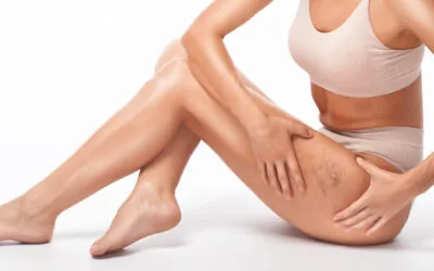 How to Prevent New Spider Veins After Sclerotherapy
